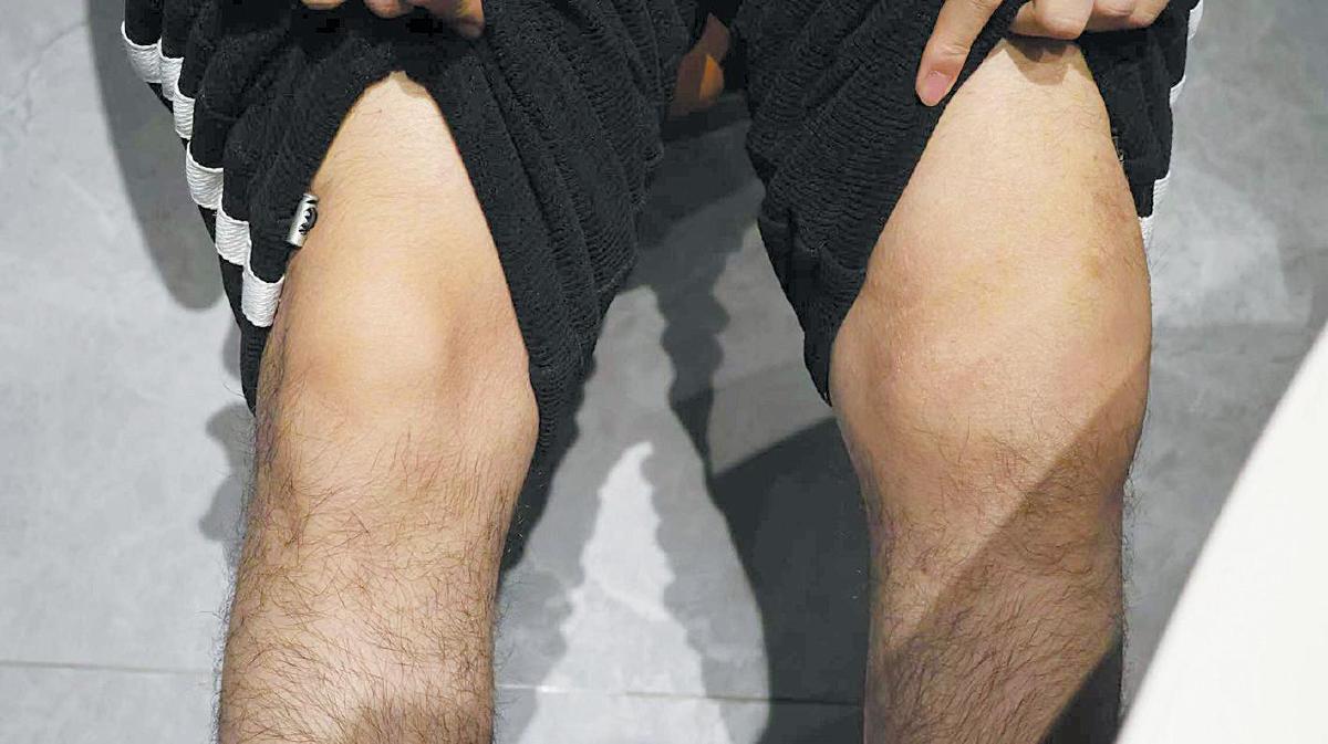 巨额血友病骗保案 蓄意诈骗医保基金还是“我不是药神”